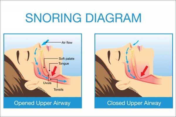 mandibular appliances for snoring